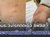 เตือนระวังโรคติดเชื้อ ซิฟิลิส – HIV หลังระบาดหนักมากที่ จ.มหาสารคาม พุ่งสูงแตะเกือบ 500 คน