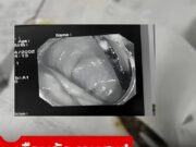 เกือบจัดงานศพ หนุ่มปวดท้องเป็นเดือนๆ ไม่หาย หมอผ่า “สิ่งนี้” ออกมา ตาตื่นทั้งครอบครัว!