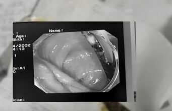 เกือบจัดงานศพ หนุ่มปวดท้องเป็นเดือนๆ ไม่หาย หมอผ่า “สิ่งนี้” ออกมา ตาตื่นทั้งครอบครัว!