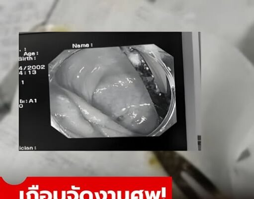 เกือบจัดงานศพ หนุ่มปวดท้องเป็นเดือนๆ ไม่หาย หมอผ่า “สิ่งนี้” ออกมา ตาตื่นทั้งครอบครัว!