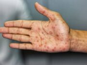 เปิด 5 จังหวัดน่ากังวล ยอดผู้ติดโรคทางเพศสัมพันธ์เพิ่ม