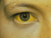 ควรระวัง! ร่างกายมีอาการคัน 2 ส่วนนี้ อาจเป็นสัญญาณของ “มะเร็งตับ” ไม่ใช่อาการแพ้