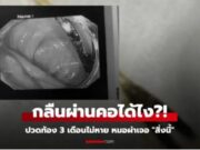 เกือบจัดงานศพ หนุ่มปวดท้องเป็นเดือนๆ ไม่หาย หมอผ่า “สิ่งนี้” ออกมา ตาตื่นทั้งครอบครัว!