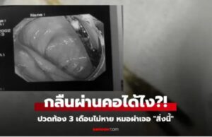 เกือบจัดงานศพ หนุ่มปวดท้องเป็นเดือนๆ ไม่หาย หมอผ่า “สิ่งนี้” ออกมา ตาตื่นทั้งครอบครัว!