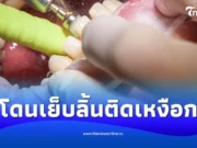 สาวไปผ่าฟันคุด แต่โดนเย็บลิ้นติดเหงือก พีกสุดหมอบอกแบบนี้
