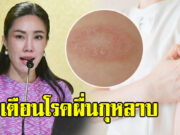 เตือนโรคผื่นกุหลาบ พบบ่อยในช่วงฤดูฝน มักเกิดกับผู้หญิง