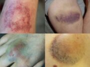 ถ้ามีเซลล์มะเร็งในร่างกาย อวัยวะ 5 ส่วนนี้อาจเริ่ม “ดำคล้ำ” อย่างผิดปกติ อย่าชะล่าใจ!