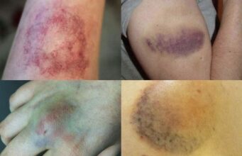 ถ้ามีเซลล์มะเร็งในร่างกาย อวัยวะ 5 ส่วนนี้อาจเริ่ม “ดำคล้ำ” อย่างผิดปกติ อย่าชะล่าใจ!