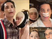 เอมี่ ศัลยกรรมย้อนวัยที่เกาหลี ซี แก้จมูกใหม่ใช้กระดูกซี่โครง เผยโฉมความสวยหล่อ