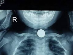 ลูกสาว 3 ขวบ เล่นกับพ่อบนเตียง จู่ๆ อาเจียนดับสลด หมอตรวจศพถึงรู้ “กิน” อะไรเข้าไป