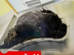 ลูกสาววัย 14 บ่นปวดท้องเกืบครึ่งปี แม่สุดช็อก เมื่อเห็นสิ่งที่หมอผ่าออกจากกระเพาะ