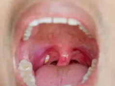 จู่ ๆ รู้สึกเหมือนมีอะไรติดคอ กลืนไปก็ไม่หาย…แล้วอยู่ดี ๆ มีเม็ดหลุดออกมา นี่มันคืออะไร?